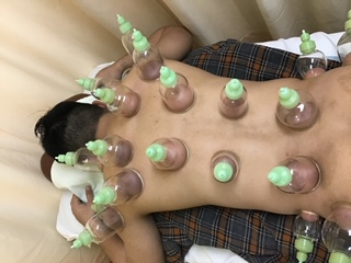 当院のおススメ治療　【カッピング療法】