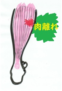 肉離れ