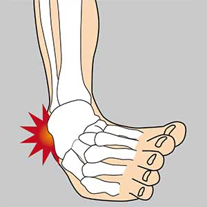 捻挫ってなに？